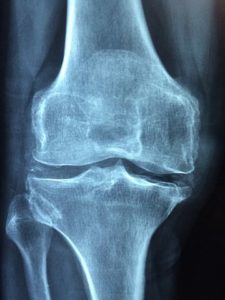 Questions & Answers About Bone Health